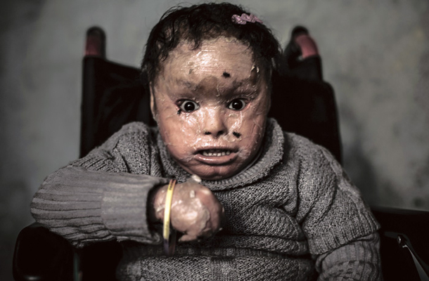 Triletna sirota Shahed trpi za neozdravljivo obliko prirojene kožne bolezni, nastale kot posledica uporabe prepovedanega belega fosforja, s katerim je izraelska vojska bombardirala Gazo v času, ko je bila njena mati noseča.
