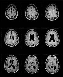 Slike možganov bolnikov z multiplo sklerozo, narejene s pomočjo magnetnoresonančne tomografije. Svetle lise so znaki vnetja.