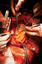 Šestinsedemdesetletni bolnici so med operacijo naredili dva posega: najprej so ji operirali zoženo vratno arterijo, nato pa so ji na srcu naredili še dva koronarna obvoda. Pri by-passu najprej navadno iz noge vzamejo žilo, ki jo potem kot obvod prišijejo na žilo v srcu tako, da se večji del krvnega obtoka izogne zamašenemu delu. 