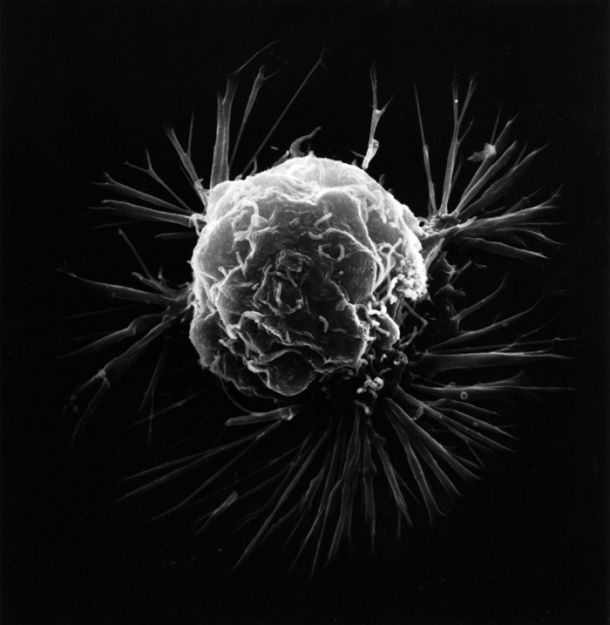 Rak dojke pod elektronskim mikroskopom 