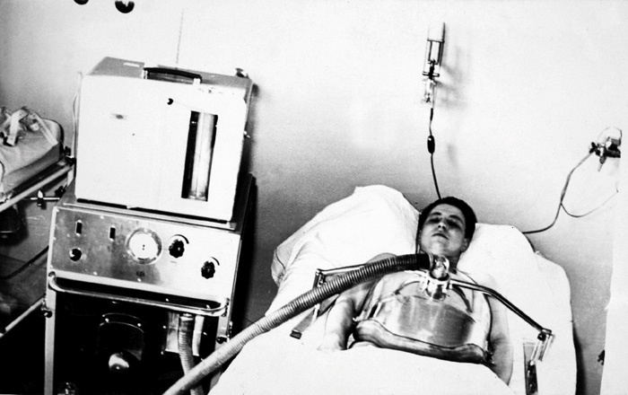 60 let nazaj. Bolnik z otroško paralizo, priklopljen na respirator.