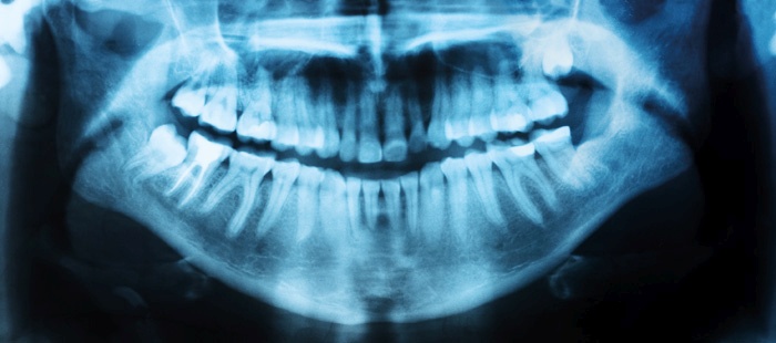 Rentgenska slika celotnega zobovja (ortopan). Rentgensko slikanje zgolj za potrebe ocenjevanja starosti prosilcev za azil je v Sloveniji obvezno, kljub negativnim stranskim učinkom.