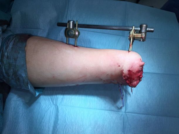 14-letniku so morali zdravniki zaradi hude poškodbe s petardo odrezati obe roki v predelu zapestja