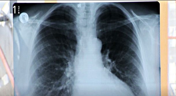 V 20 letih so odkrili kar 450 primerov raka, z azbestom je povezan zlasti rak pljučne in trebušne mrene (na sliki).